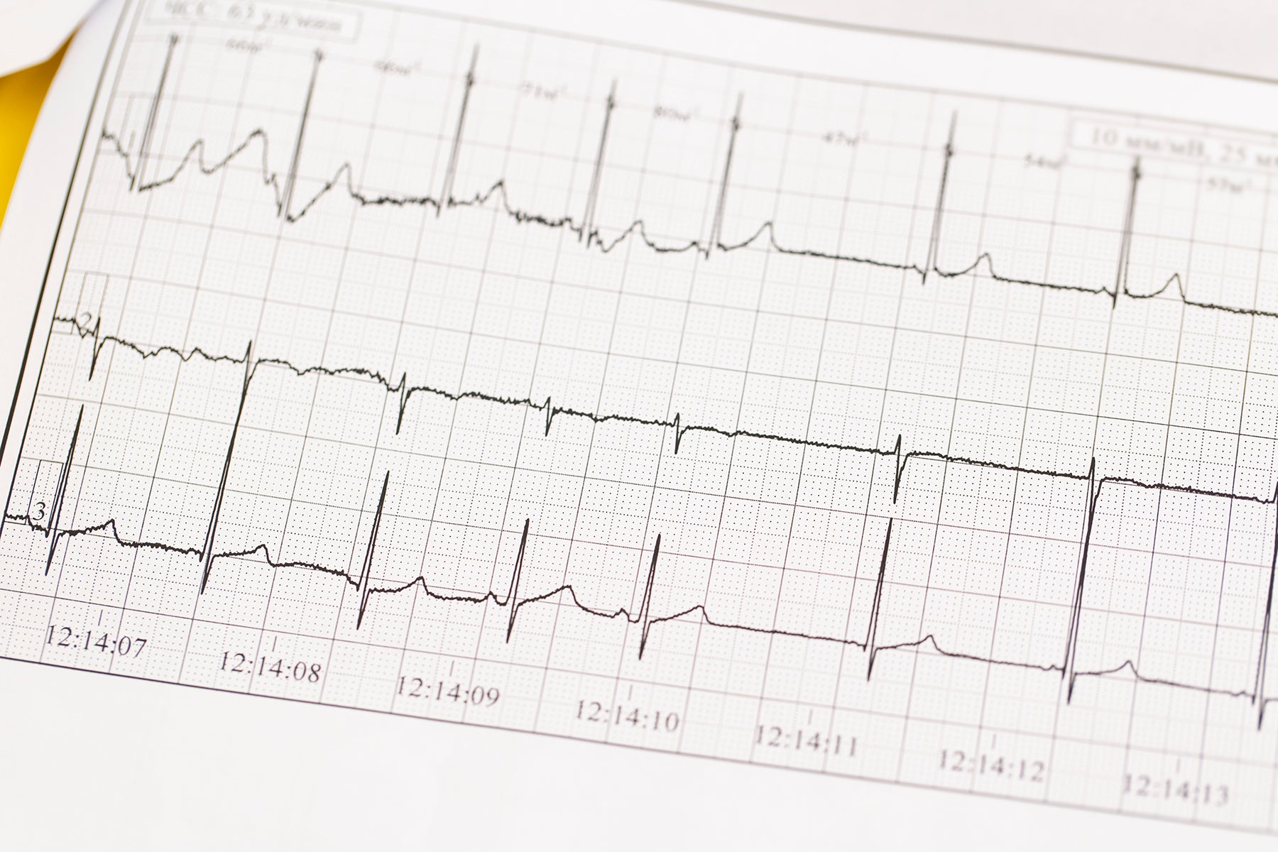close-up-of-ecg-electrocardiogram-the-work-of-a-2023-11-27-05-34-35-utc.jpg